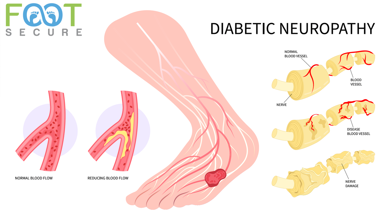 DIABETIC NEUROPATHY image